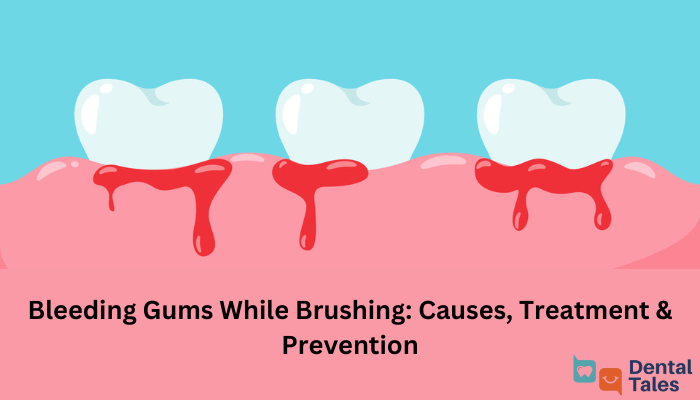 Bleeding Gums While Brushing Causes, Treatment & Prevention