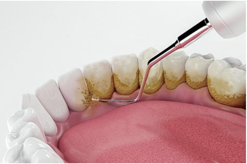 Dental Plaque Dental Plaque