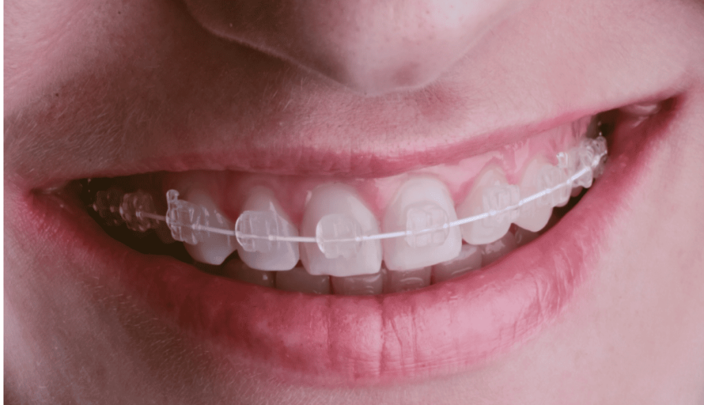 Monocrystalline Ceramic Braces Monocrystalline Ceramic Braces