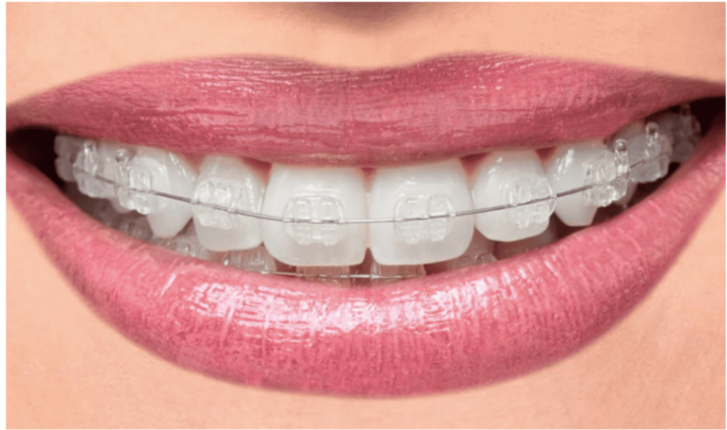 Polycrystalline Ceramic Braces Polycrystalline Ceramic Braces